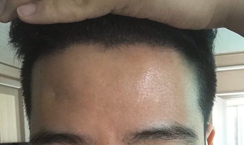 Current Status of M-shaped Hair Transplantation in the 4th Month