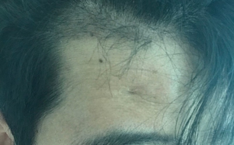 M-shaped hair transplant day 70 review, please look at the top of the head