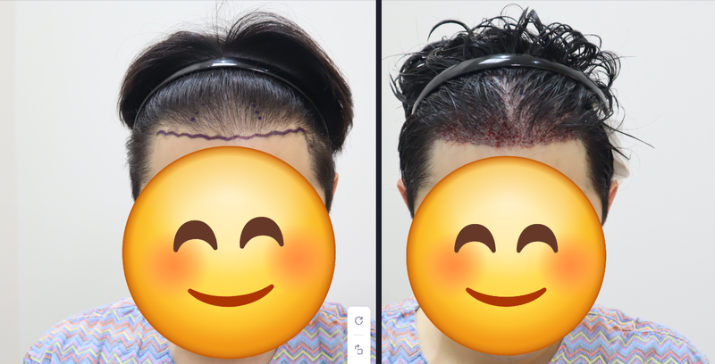 [밴스모자이너의원]30대후반 비절개 투블럭컷 2836모 이식(9년만에 재수술)