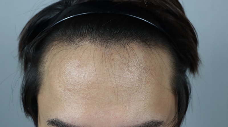 It's been a year since my m-shaped hair transplant