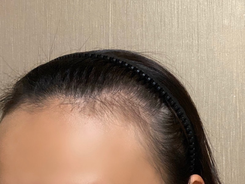 2600모 비절개 헤어라인 모발이식 했어요~ 벌써 9개월!