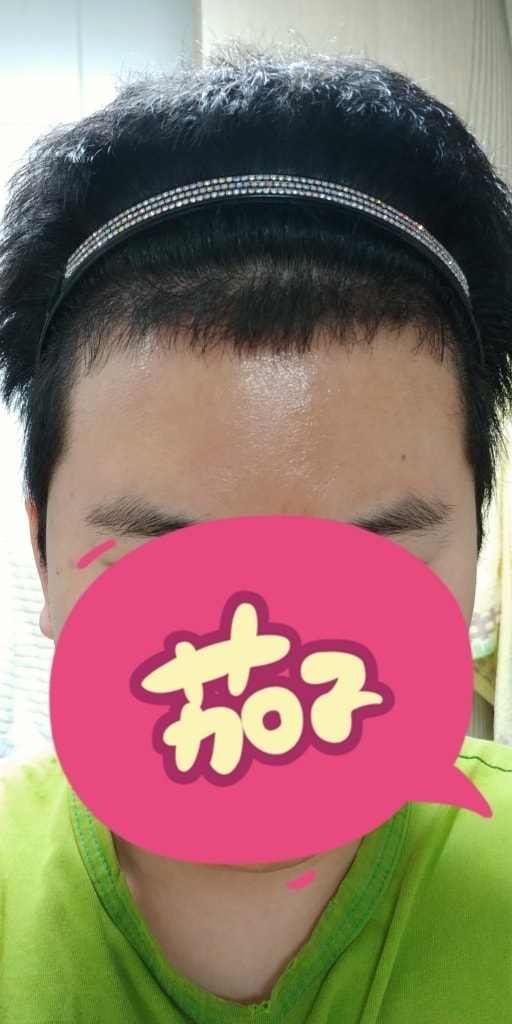 毛在成整形外科 4 个月了