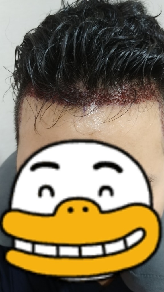毛在性手术后。
