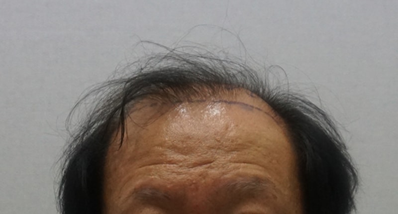 수술전.jpg