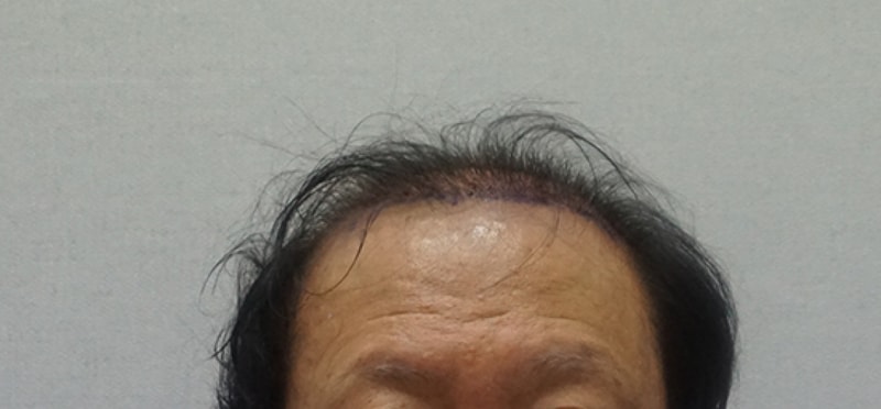 수술다음날.jpg