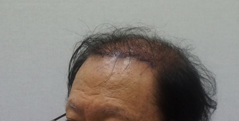 수술다음날2.jpg