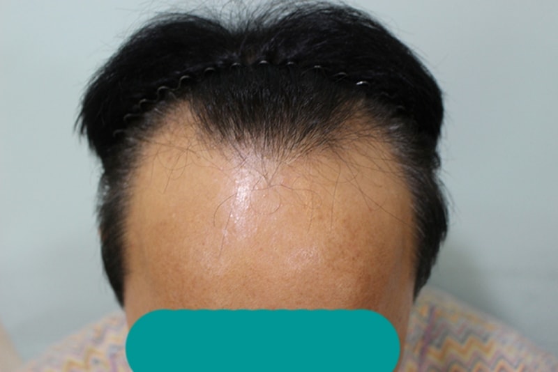절개 5천모 열흘됐네요. 디자인 평가 부탁합니다.