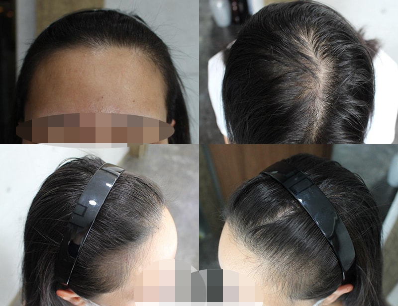 ヘアラインと頭頂部を移植して5ヶ月になりました