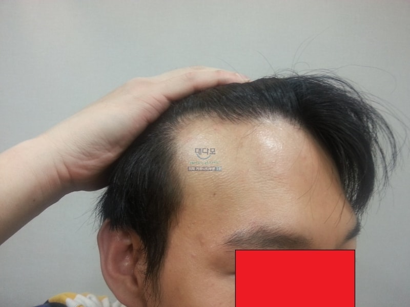 切開 3300毛 2年後のレビューを投稿します 久しぶりですね^^