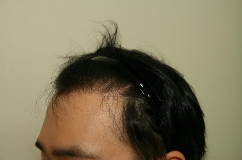 크기변환_수술후1년3.JPG