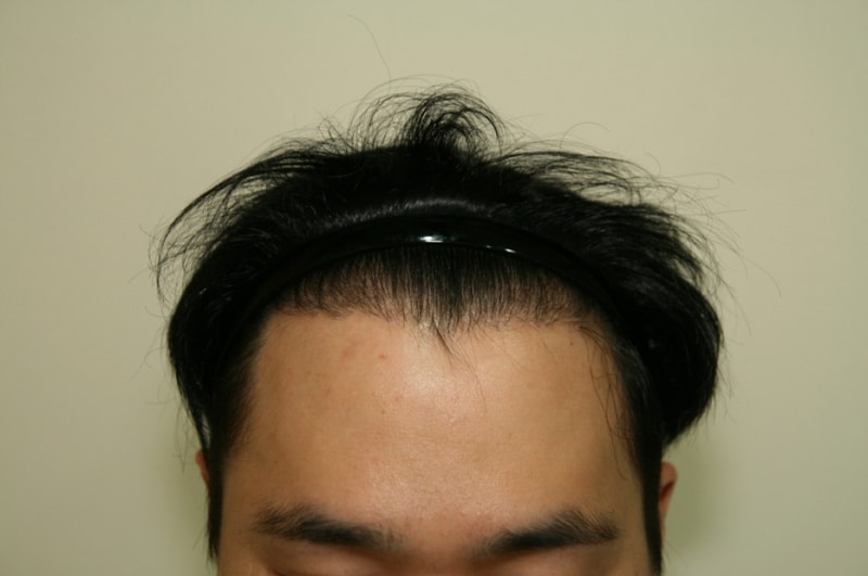 크기변환_수술일년뒤1.JPG