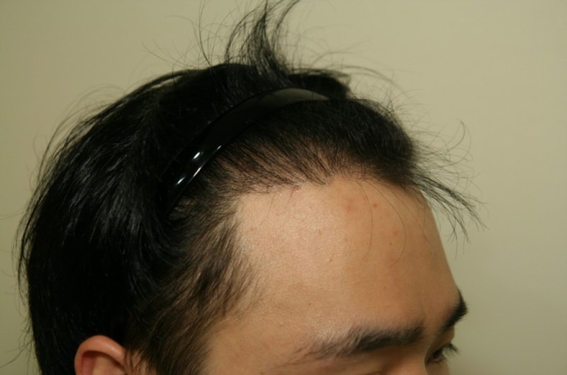 크기변환_수술후1년4.JPG