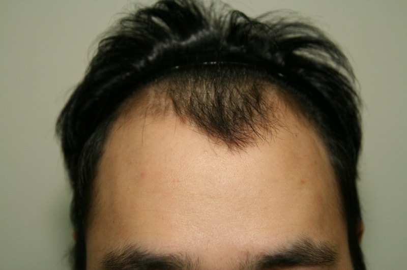 크기변환_수술전1.JPG