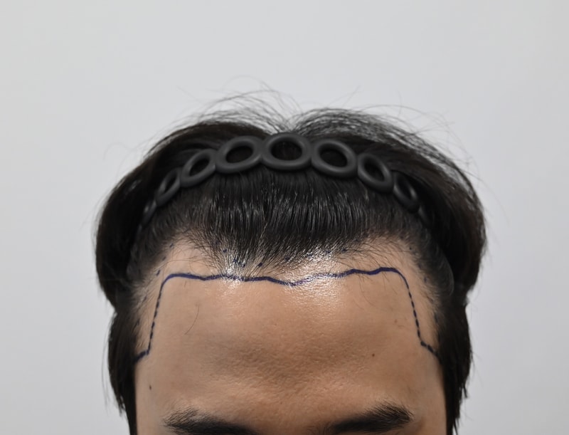 이식전_디자인_정면.JPEG