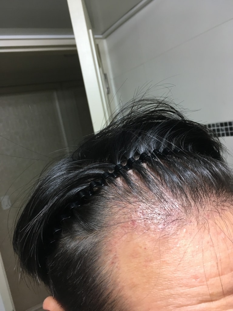 이식 47일차 암흑기를 지나고 있습니다..^^