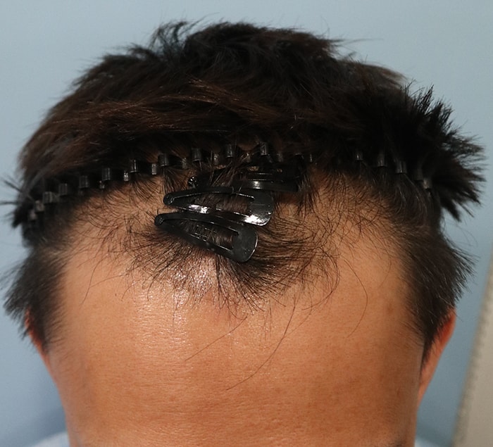 3600 Mo of Emza Hair Loss Reported After 6 Months