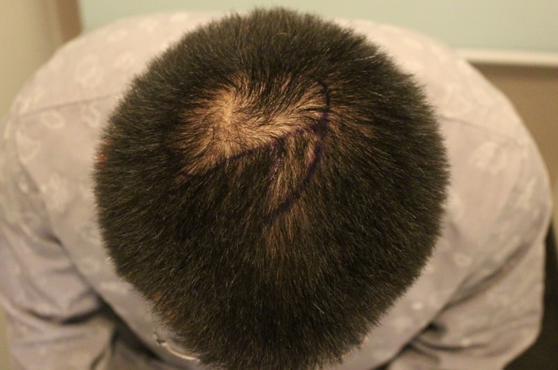 Compound 4,500 hair for 8 months, fill the M shape, and reinforce the number of hairs on and around the top of the head