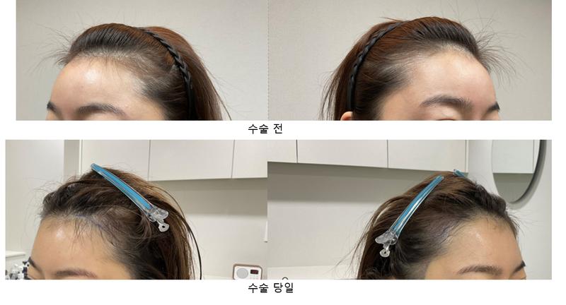 바람부는날에도  비절개(14일차)  모발이식후기