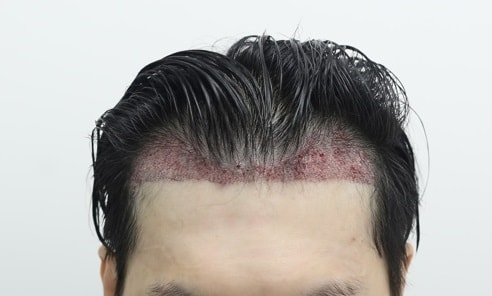 수술 후.jpg