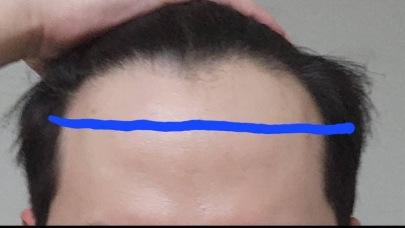 모발이식 130일차