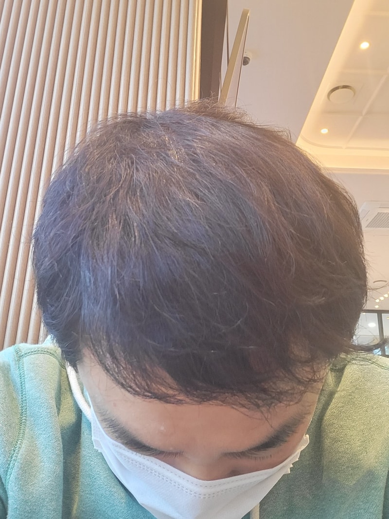 모발이식 1년차 후기 입니다.