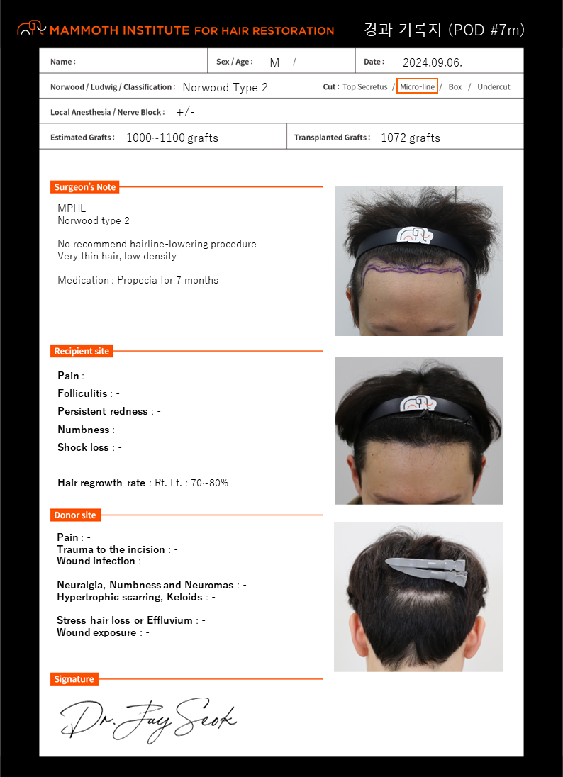 This is the 7th month of Mammoth Hairline Clinic's non-cut hair transplant surgery.