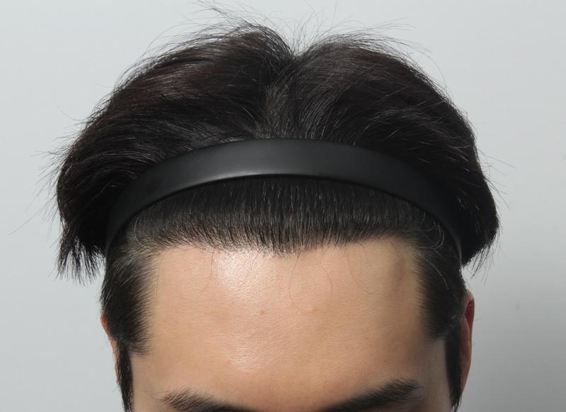 모아트의원/비절개/1년 후기 입니다
