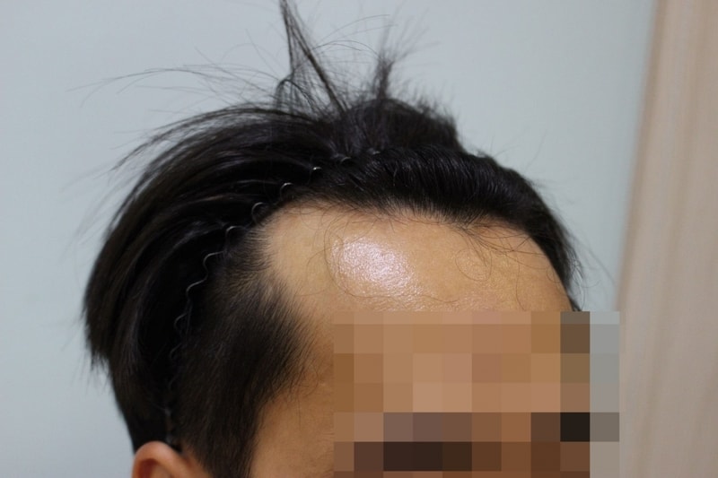M자 비절개 3000모 3개월까지..