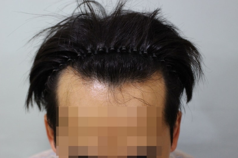 수술전허전한내머리3.jpg