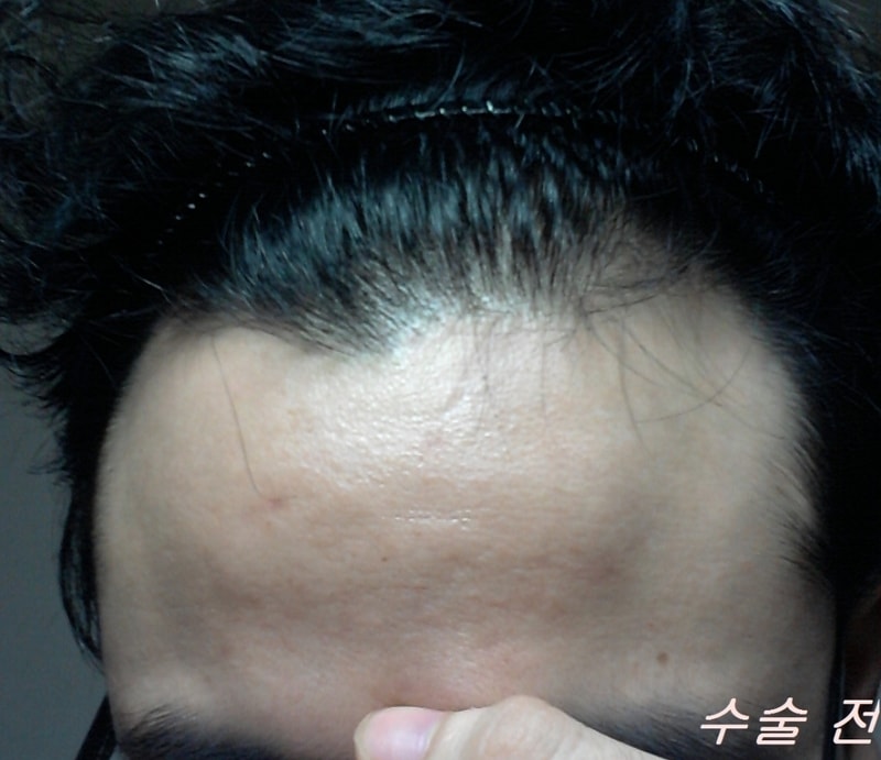 국내 포헤어 모발이식 <비절개 1200모낭>
