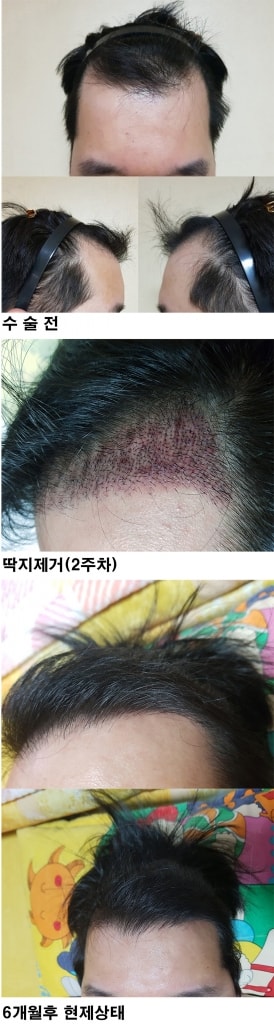 6개월차후4.jpg