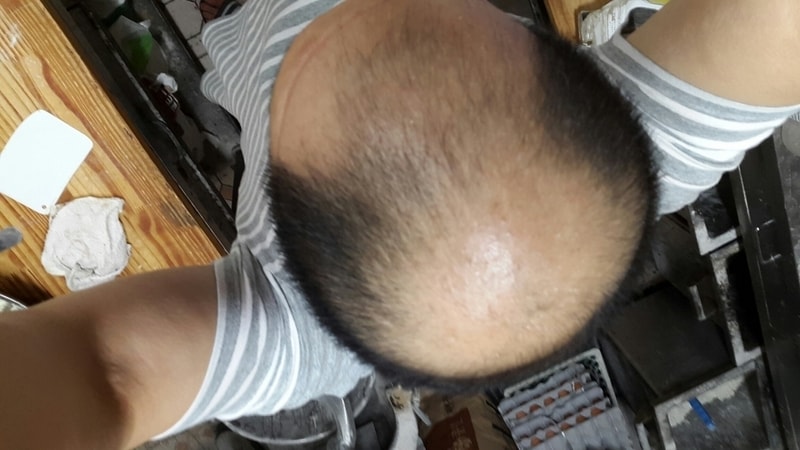 이식8개월차