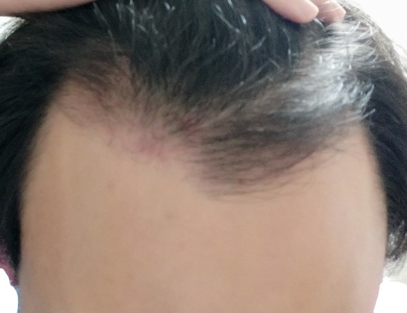뉴헤어 절개 1700모낭 모발이식 3개월 후기