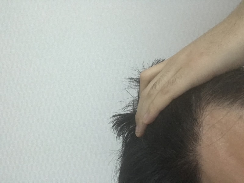 모재성 2600모 비절개 수술 1년차 후기 올립니다