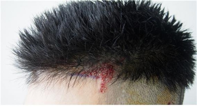 Right after 500 hair follicle incision ~ 4 months