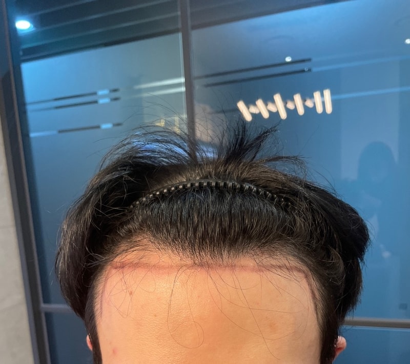 122일 됐습니다. 좌우 차이가 너무 많이 나요ㅠ 시간이 해결해주는 부분인가요?