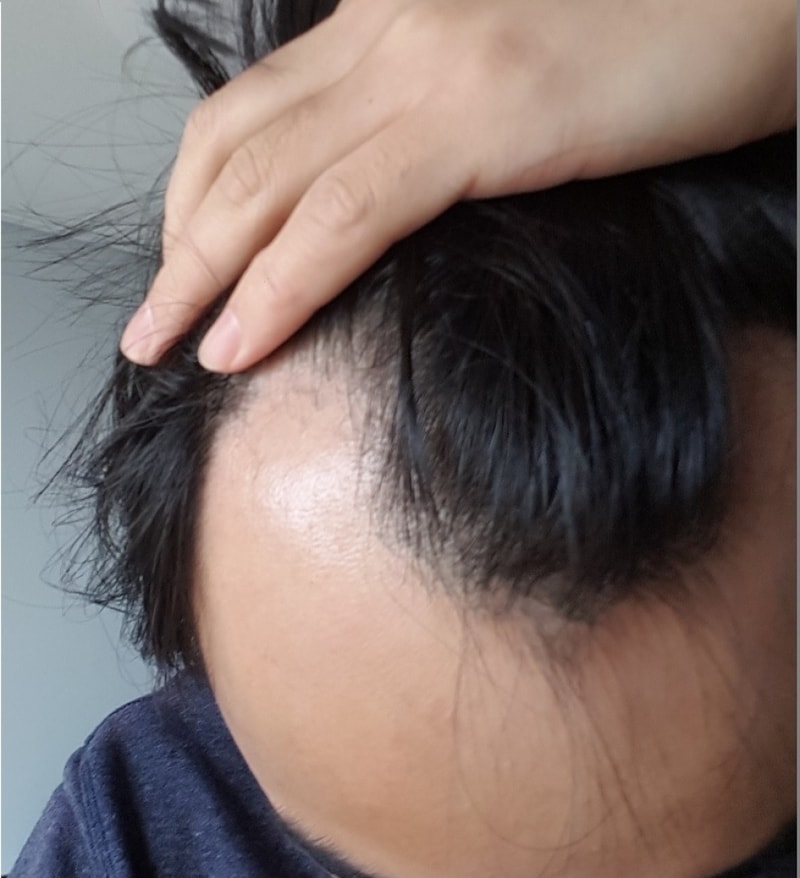 Dr. Charm / Day 1 of 1300 hair follicle non-excision