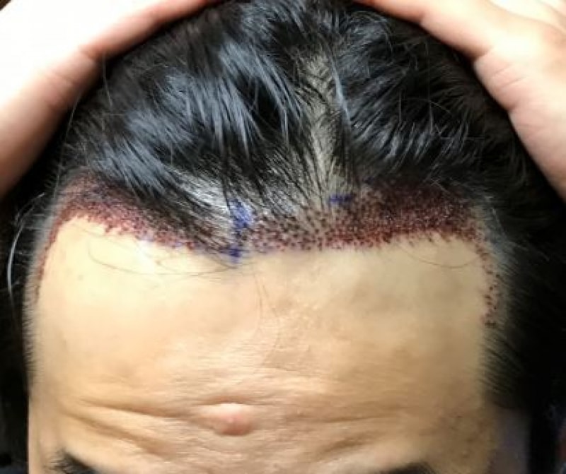 모재성에서 918모낭 오늘 수술했습니다 평가좀요!