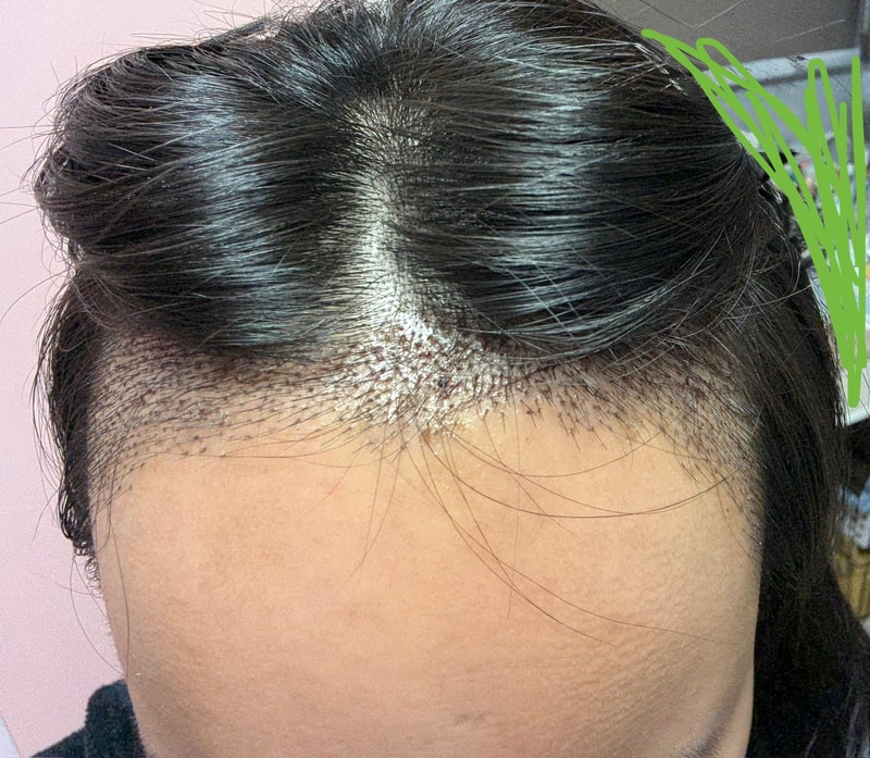 A review of the female hairline Hair Transplant at Apgujeong Mo Woo-rim Clinic