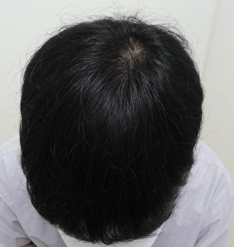 ZARADA议员接受头顶移植9个月后期