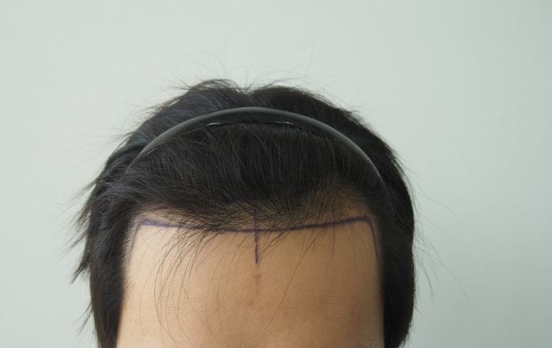 Evaluation photograph immediately after parent non-intersecting surgery