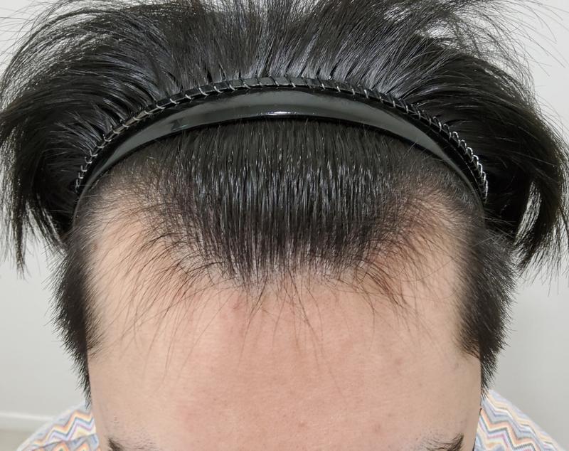 비절개 모발이식 1년 경과 공유하겠습니다~~