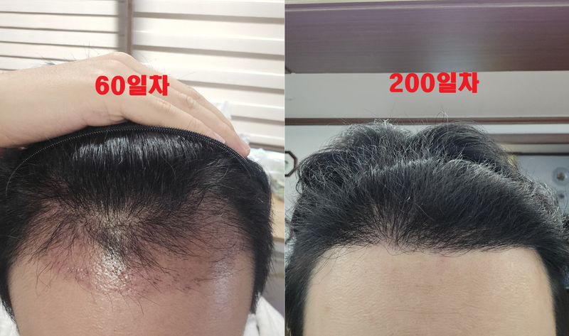 ノブライン移植200日目です~（暗黒期過ぎました）