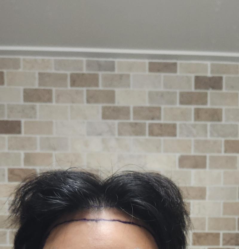 [자라다의원] 모발이식 수술 3일차