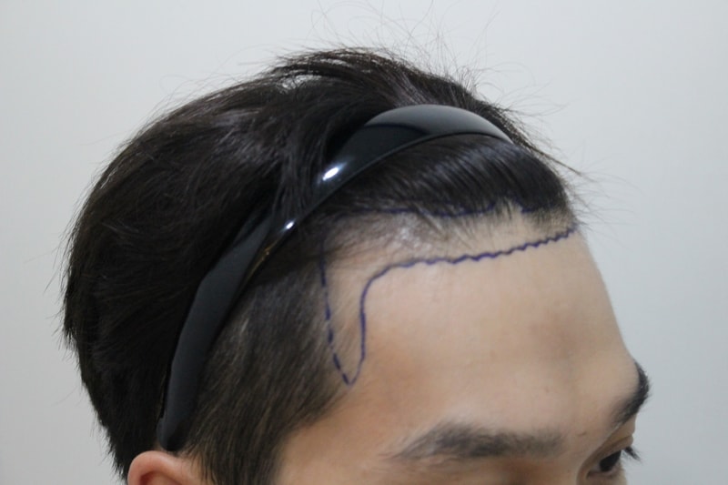 수술하고 7개월째인데 여친도 좋아하네요...