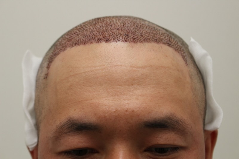 手術してからもう一ヶ月になりました