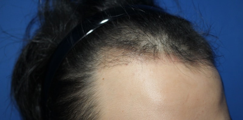 It's 1830 hair incision for 4 months