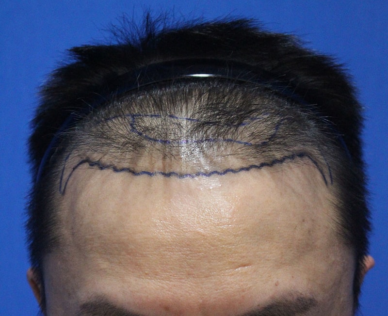 It's been more than seven months, and it's amazing to see my hair grow the same way I transplanted it