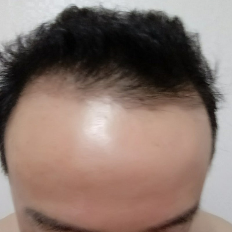 5.수술2개월째.jpg