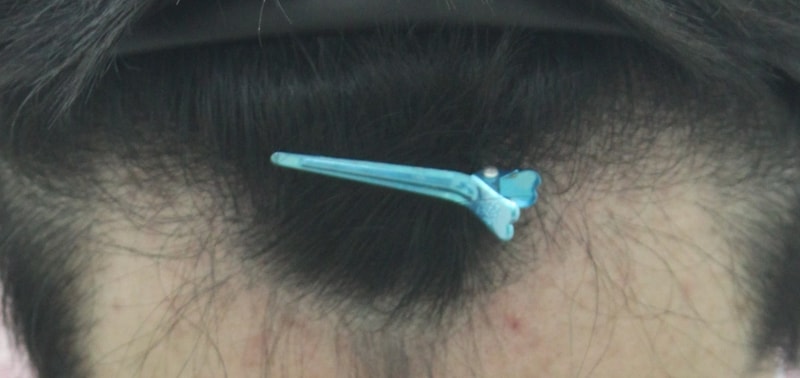 수술전정면.jpg